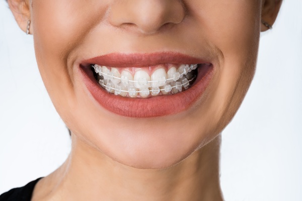 Clear Braces Vs  Aligners:   Important Differences To Keep In Mind