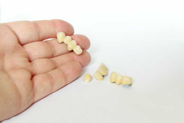 When A Dental Bridge May Be Better Than A Dental Implant