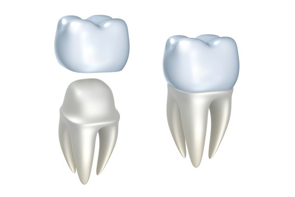 Difference Between Caps And Crowns And Do General Dentists Do Both?