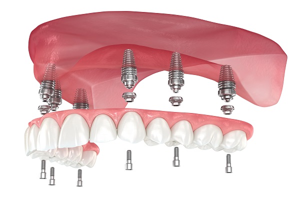 Implant Supported Dentures Santa Ana, CA