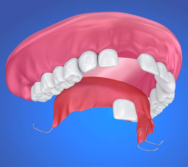 Santa Ana Partial Denture for One Missing Tooth