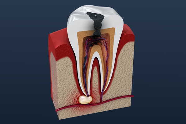 FAQs About Root Canal Treatment